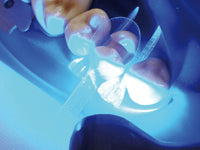 Tofflemire Contoured Transparent Matrices