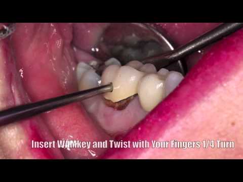 WAMKEY Crown Remover